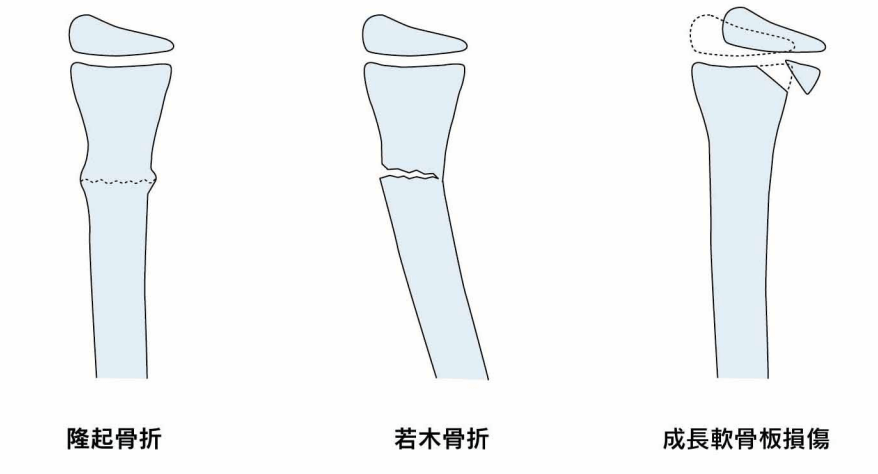 小児の骨折について