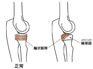 肘内障について