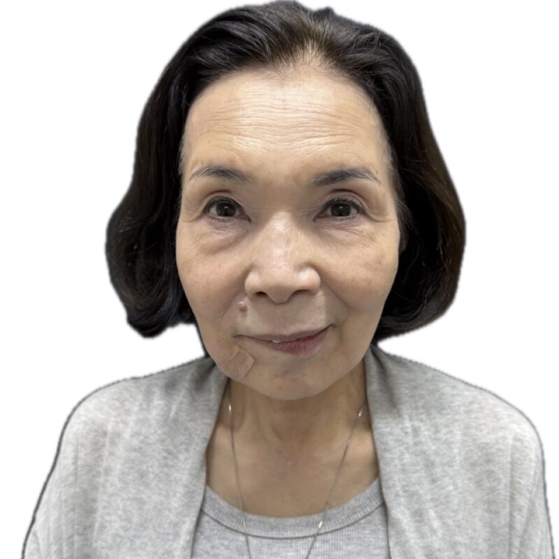 施術前